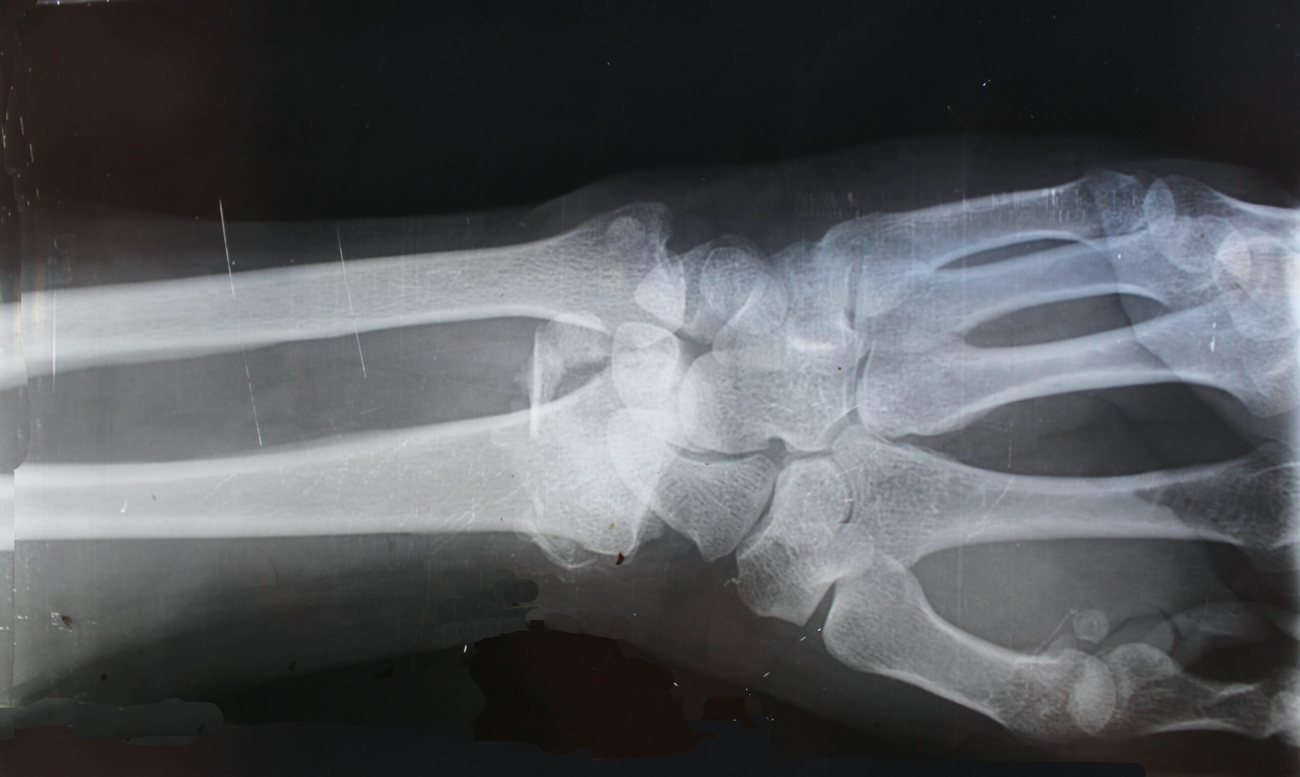 xray depicting musculoskeletal injuries in construction